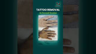 New Beginnings Your Guide to Tattoo Removal [upl. by Valdemar]