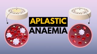 Aplastic Anaemia Causes Signs and Symptoms Diagnosis and Treatment [upl. by Natasha328]