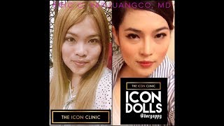 Nose Job  Asian Rhinoplasty RealPeople RealResults IconDolls IconWarriors TheIconClinic [upl. by Nileve]