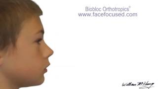 Dr Hangs Biobloc Orthotropic ® Treatment  Morph [upl. by Adlih]