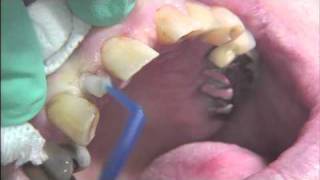 Mini Dental Implant for Replacement of Missing Tooth Maxillary Lateral Incisor [upl. by Amsa]