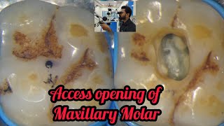 Access opening of Maxillary Molar step by step demonstration  rct for beginners  dental lectures [upl. by Daniela363]