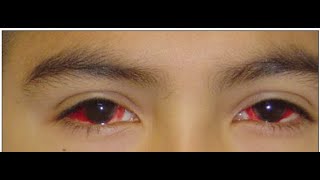 Pediatric Ophthalmology Lecture Preview [upl. by Fields885]