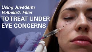 Using Juvederm Volbella® Filler To Treat UnderEye Concerns at ZO Skin Centre [upl. by Donadee]