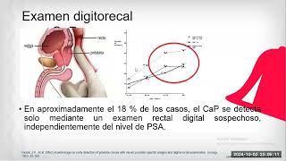 CANCER DE PROSTATA 2024II [upl. by Townsend]