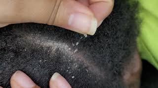 Finger Nails Dandruff Scratching  Husbands Scalp  Lifting Flakes amp Scabs  ASMR No Talk  307 [upl. by Esinad]