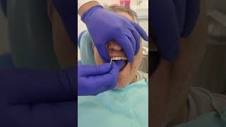 🦷 Implantes Dentales La Solución Definitiva para una Sonrisa Perfecta implantesdentarios shorts [upl. by Pember]