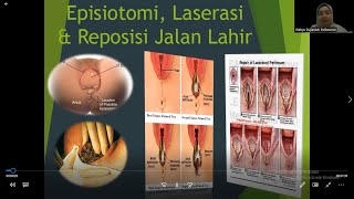 Episiotomi Laserasi dan Penjahitan [upl. by Wong]