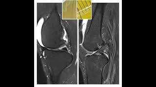 Gouty arthritis VS Degenerative arthritis [upl. by Eibo]