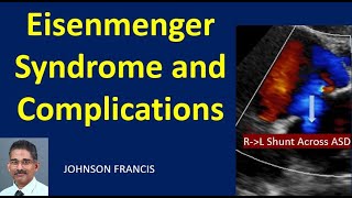 Eisenmenger Syndrome and Complications [upl. by Noswal990]