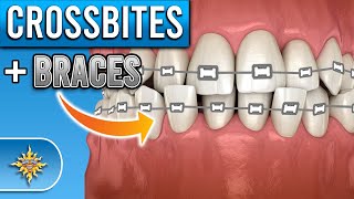 How Do BRACES Fix Crossbites [upl. by Hillier]