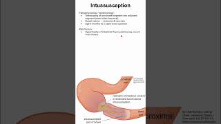 Intussusception [upl. by Eversole]