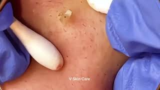 V Skin Care Remove ACNE FAST With These Treatment Secrets 65 [upl. by Aneala]