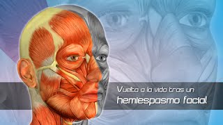 Hemiespasmo Facial Clínica Las Condes [upl. by Aneleve237]