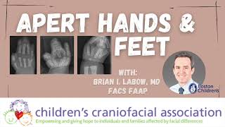 Apert Hands and Feet  with Dr Labow [upl. by Gnart597]