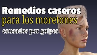 Remedios caseros para los moretones causados por golpes [upl. by Weigle]