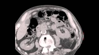 CT Abdomen Pelvis Renal Cysts Seminal Vesicle hemorrhage Discussion by Radiologist [upl. by Zzaj]