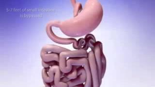 MGB Mini Gastric Bypass surgical procedure Animated version [upl. by Schweitzer]