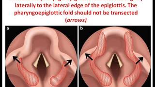 Laryngomalacia surgery main key point [upl. by Dis827]