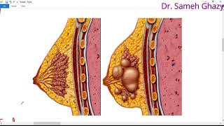 Systemic pathology 66  Breast 1  fibrocystic disease and benign tumors [upl. by Nwahsar]