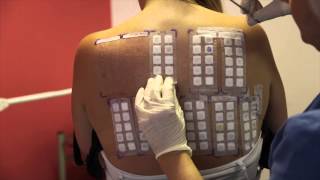 Skin Allergy Testing Using Patch Tests [upl. by Hcab]