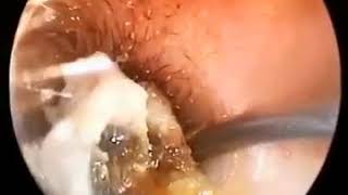 Earwax Removal Extractions The Moment Pull Out Cholesteatoma 胆脂瘤取出瞬间 外耳道挖耳屎清理 耳垢 [upl. by Feeley495]