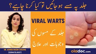 Viral Warts Causes amp Treatment  Skin Ke Masse Ka Ilaj  Warts On Face Hand amp Feet Removal [upl. by Rosner984]