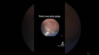 Like booger removal Polyps are even more satisfying satisfying medical nose doctor [upl. by Shult117]