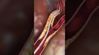 Carotid embolic prevention  animationshorts shortsfeed youtubeshorts viralshorts [upl. by Grosvenor48]