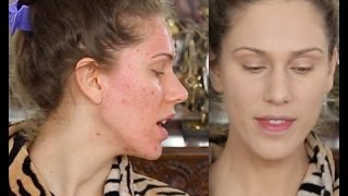 Acne Scar Foundation Routine  Full Coverage Flawless Makeup Tutorial  Pores amp Ice Pick Scarring [upl. by Ardnoyek]