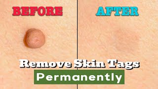 5 Fast Home Remedies to Remove Skin Tags amp Warts [upl. by Iluj]