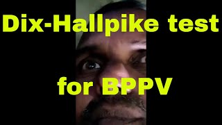 DixHallpike testmanoeuvre for BPPV Benign Paroxysmal Positional Vertigo [upl. by Yatnwahs]