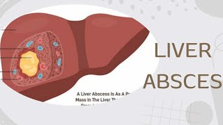 TOPICquot30LIVER ABSCESSamp ITS CAUSES SIGN SYMPTOMS DIAGNOSIS AND TREATMENT [upl. by Crowns]