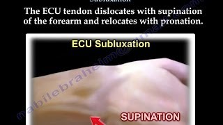 Extensor Carpi Ulnaris Subluxation  Everything You Need To Know  Dr Nabil Ebraheim [upl. by Pepper330]