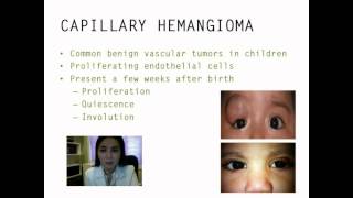 Periocular capillary hemangioma management  Video abstract 39029 [upl. by Azeria]