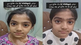 برص  Vitiligo  2 ماہ علاج سے پہلے اور 2 ماہ علاج کے بعد ریزلٹ [upl. by O'Brien]