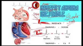 NSTEMI vs Angina Inestable Electro [upl. by Reema33]