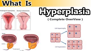 What is hyperplasia   Clear Over View [upl. by Aiekahs]