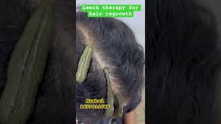 What is the best therapy for hair growthkzhijamaleechhairreelsviralshortstrendingyoutube [upl. by Leasia]