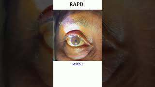 RAPD testing  Optic nerve test  Swinging flash light test eyecareoptom shorts rapd short eye [upl. by Knowlton]