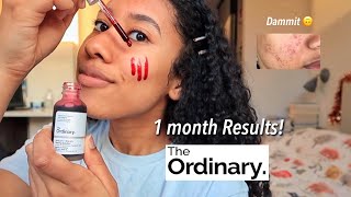 The Ordinary Peeling Solution before and after Review 12 weeks [upl. by Wera]