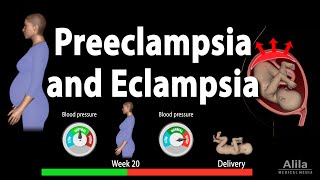 Preeclampsia and Eclampsia Animation [upl. by Ecyt]