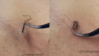 Removing Long Ingrown Hair From Armpit [upl. by Melony]