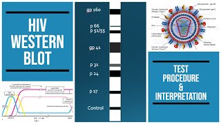 HIV western blot  SDS gel  procedure  Interpretation  pathology pathologylab biochemistry [upl. by Leonanie282]