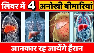 चौंक जाएंगे ये 4 बीमारियां आपके लिवर को चंद दिनों में बर्बाद कर सकती हैं  Types of Liver Disease [upl. by Assilat101]