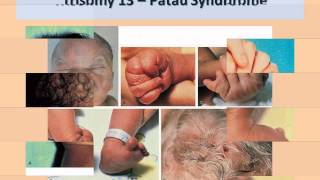 Approach to a Newborn with Dysmorphic FeaturesDr Prakash Manikoth FRCPCH [upl. by Rafaelita136]