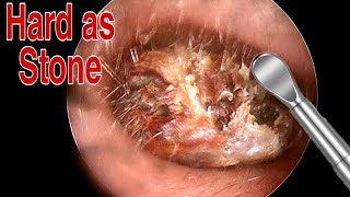 BIGGEST Ear Wax Difficult Removal  EP2  Doctor Anh [upl. by Aggi]