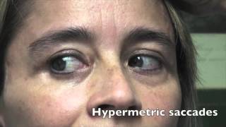 Case Challenge The patient had hypermetric saccades Video 1 [upl. by Parnas]