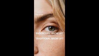 Brow Lift Surgery  Endoscopic vs Traditional Brow Lift with Dr Guy Massry [upl. by Rissa486]