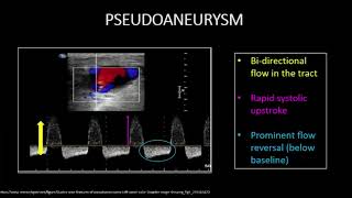 Peripheral Artery Ultrasound Interpretation  15 Minute Radiology CME [upl. by Kisung]